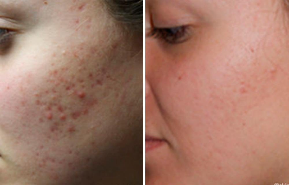 Three steps to Remove Acne Scars
