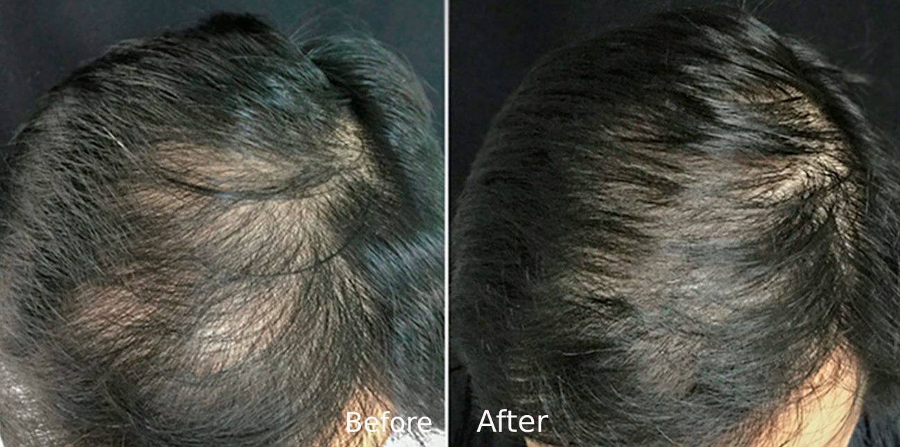 PRP hair Treatment in Lucknow