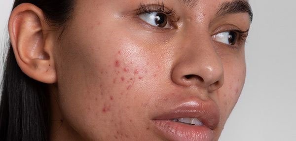 Acne Treatment In Lucknow