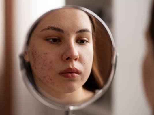 Acne Scar Reduction