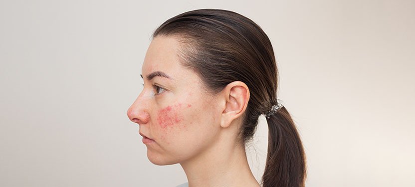 best acne treatment in Lucknow