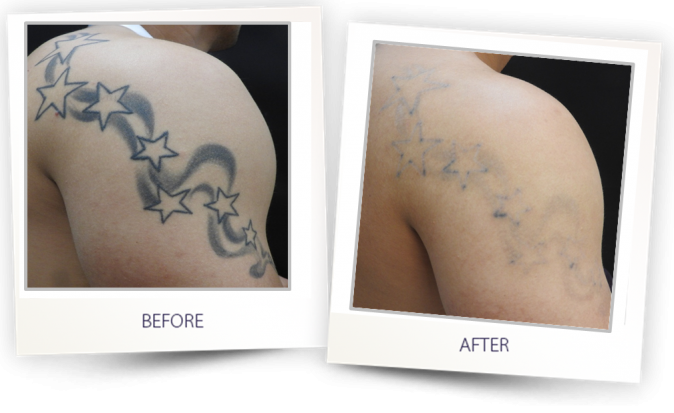Laser tattoo removal in Lucknow