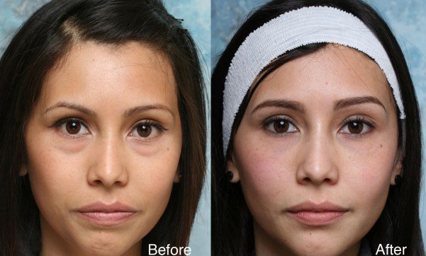 Dark circle surgery is right for you Best Dermatologist in Lucknow | Dermatologist in Lucknow