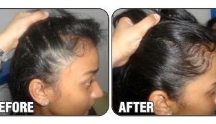 Tips to control hair fall Tattoo Removal in Lucknow