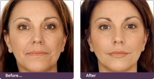 Botox treatment which gives your skin new birth 