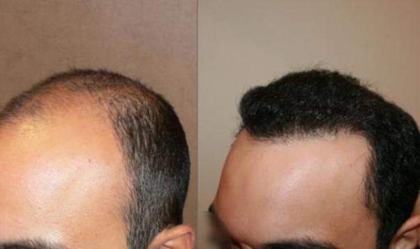 Hair transplant to get rid from the hair loss problems