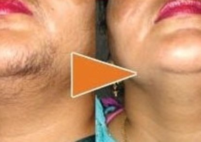 Best hair transplant in Hazratganj Lucknow