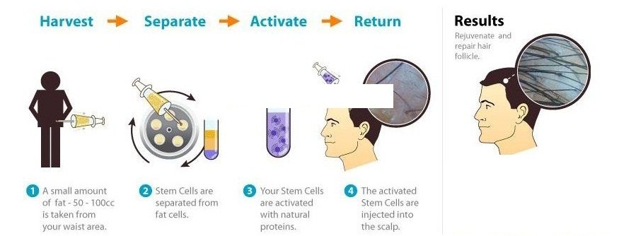 Stem cell therapy 